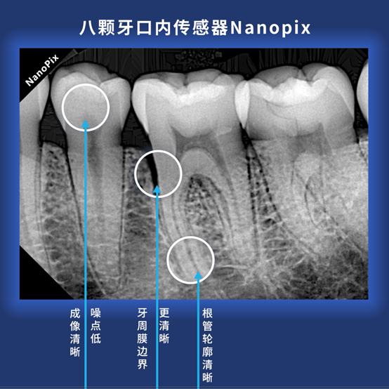 NanoPix 將根管輪廓和牙周膜邊界都開到HD高清模式